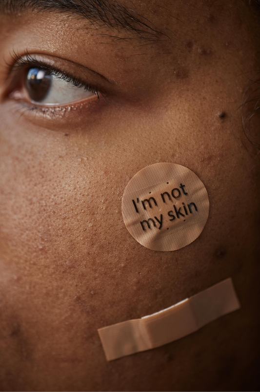 Exploring DIY Treatments for Acne Scars: Separating Fact from Fiction