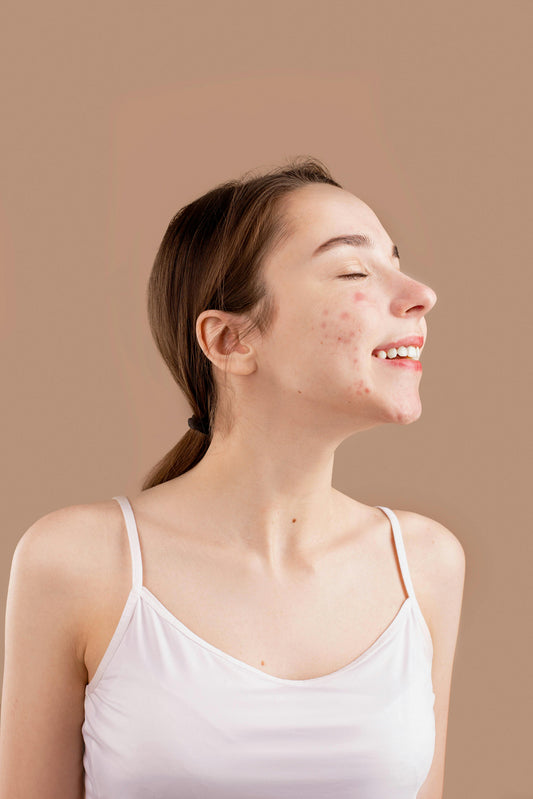 Demystifying Acne: Understanding Its Causes and Solutions