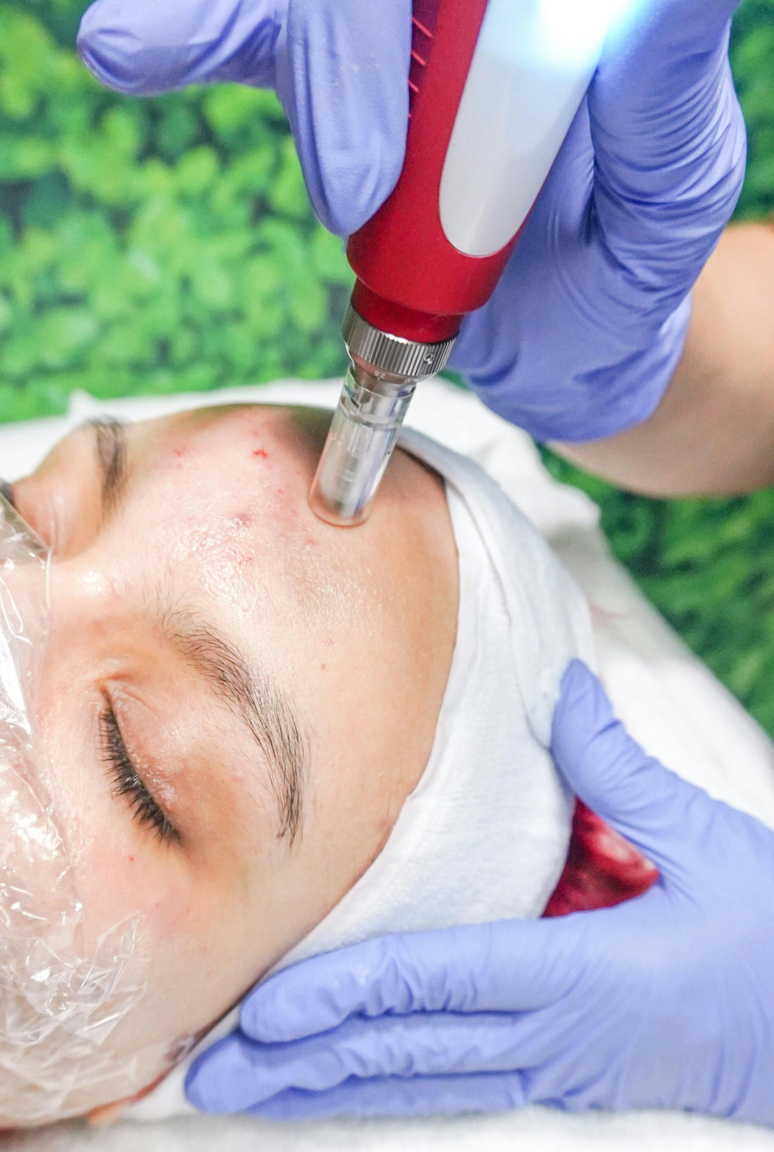 Exploring the Safety and Value of Microdermabrasion